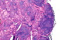 Profile Picture of Hashimoto's thyroiditis - Wikipediaon Wikipedia