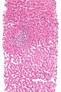 Profile Picture of Hepatotoxicity - Wikipedia, the free encyclopediaon Wikipedia