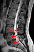 Profile Picture of Spinal disc herniationon Wikipedia