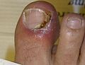 Profile Picture of Nail diseaseon Wikipedia