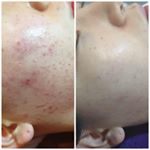 Profile Picture of 전주피부관리 라스파 (@laspa_skin) on Instagram