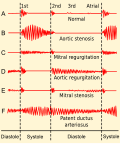 Profile Picture of Systolic heart murmuron Wikipedia