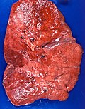 Profile Photo of Lipid pneumoniaon Wikipedia