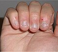 Profile Picture of Nail bitingon Wikipedia