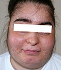 Profile Picture of Cushing's syndrome - Wikipediaon Wikipedia