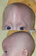 Profile Picture of Trigonocephaly - Wikipediaon Wikipedia