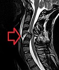 Profile Picture of Spinal cord injuryon Wikipedia