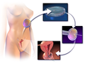 Profile Picture of Fertility fraudon Wikipedia