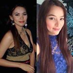 Profile Picture of Sunshine Guimary Surgery (@sunshine_guimary.before) on Instagram