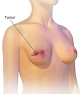 Profile Picture of Breast cancer - Wikipediaon Wikipedia