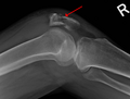 Profile Picture of Patella fracture - Wikipediaon Wikipedia