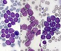 Profile Picture of Acute lymphoblastic leukemiaon Wikipedia