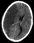Profile Picture of Brain ischemia - Wikipediaon Wikipedia