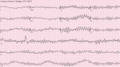 Profile Picture of Sudden arrhythmic death syndromeon Wikipedia