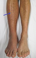 Profile Picture of Deep vein thrombosison Wikipedia