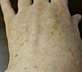 Profile Picture of Liver spot - Wikipediaon Wikipedia