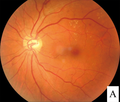 Profile Picture of Diabetic retinopathyon Wikipedia