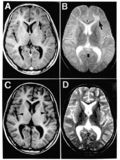 Profile Picture of Subacute sclerosing panencephalitison Wikipedia