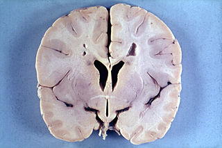 Profile Picture of Alexander diseaseon Wikipedia