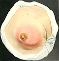 Profile Photo of Mastitis - Wikipediaon Wikipedia