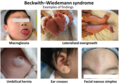 Profile Picture of Beckwith–Wiedemann syndrome - Wikipediaon Wikipedia