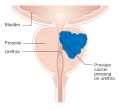 Profile Picture of Prostate cancer - Wikipedia, the free encyclopediaon Wikipedia