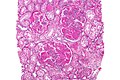 Profile Photo of Lupus nephritis - Wikipediaon Wikipedia