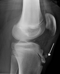 Profile Picture of Osgood–Schlatter disease - Wikipediaon Wikipedia