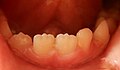 Profile Picture of Mamelon (dentistry)on Wikipedia