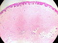 Profile Picture of Cutaneous leiomyomaon Wikipedia