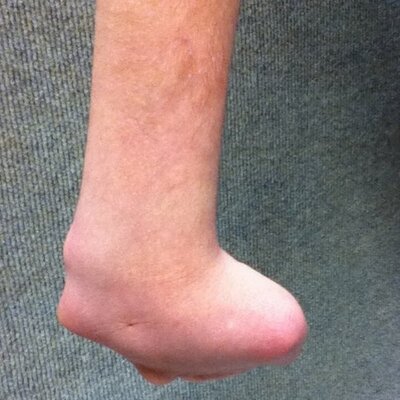 Zach Thorne's Nub - Twitter Profile Picture of Zach Thorne's Nub (@nubtubber) on Twitter