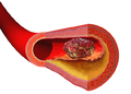 Profile Picture of Thrombosis preventionon Wikipedia