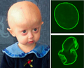 Profile Picture of Progeria - Wikipediaon Wikipedia