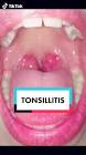 Profile Picture of   Symptoms of Tonsillitis... (@drtengkuezulia) on Tiktok