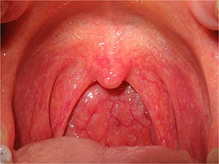 Profile Picture of Sore throaton Wikipedia