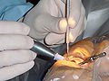 Profile Picture of Cataract surgeryon Wikipedia