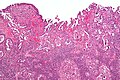 Profile Picture of Uterine serous carcinoma - Wikipediaon Wikipedia