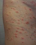 Profile Picture of Pityriasis lichenoides et varioliformis acuta - Wikipediaon Wikipedia