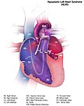 Profile Picture of Hypoplastic left heart syndrome - Wikipediaon Wikipedia