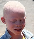 Profile Picture of Albinism in humans - Wikipediaon Wikipedia