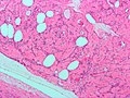 Profile Picture of Leiomyoma - Wikipediaon Wikipedia