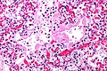 Profile Picture of Acute interstitial pneumonitison Wikipedia