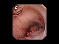Profile Picture of Ureteral canceron Wikipedia