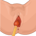 Profile Picture of Bartholin's cyst - Wikipediaon Wikipedia