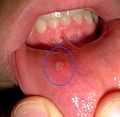 Profile Picture of Mouth ulceron Wikipedia