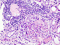 Profile Photo of Rapidly progressive glomerulonephritison Wikipedia