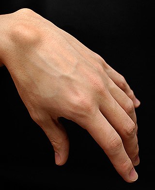 Profile Picture of Ganglion cyston Wikipedia