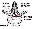 Profile Picture of Spinal stenosison Wikipedia