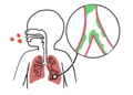 Profile Picture of Bronchiolitis - Wikipediaon Wikipedia