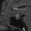 Rathke's cleft cyst - Wikipedia - Wikipedia Profile Picture of Rathke's cleft cyst - Wikipediaon Wikipedia